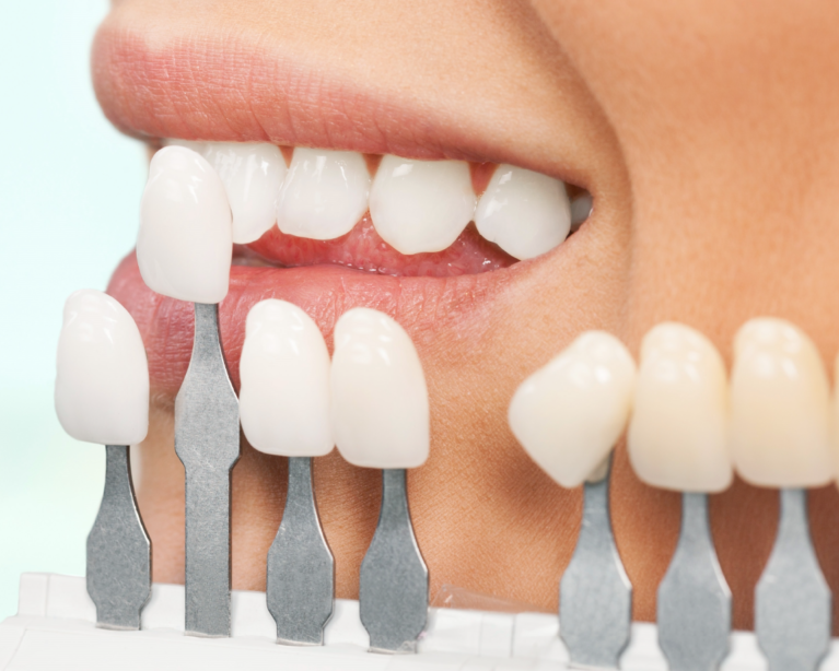 Porselen Kaplama hakkında bilinmesi gerekenler